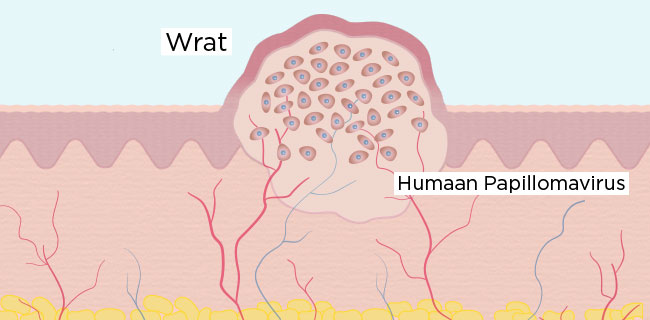 Warzen